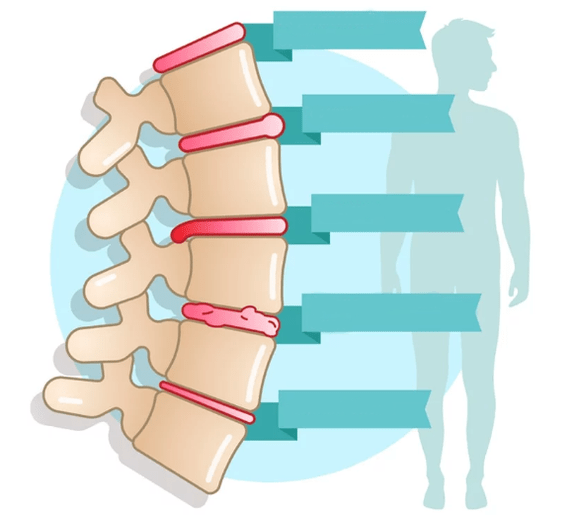 Erkrankungsgrad der Thorax -Osteochondrose