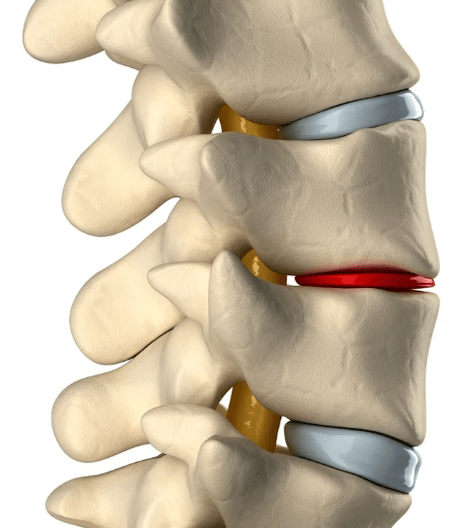 Osteochondrose der Brustwirbelsäule