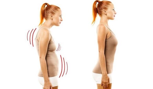 gerader Rücken und schlechte Körperhaltung mit zervikaler Osteochondrose