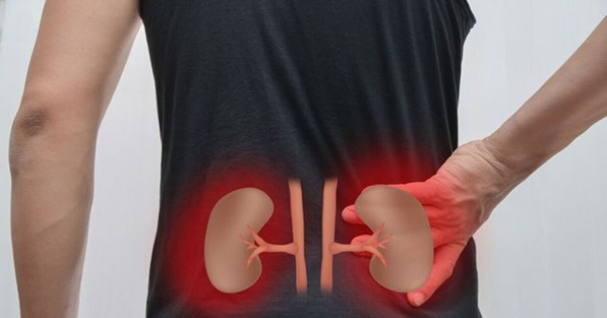 Nierenerkrankung als Ursache für Schmerzen im unteren Rückenbereich